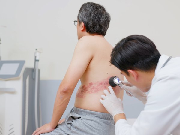 Herpes zóster (culebrilla): síntomas, tratamiento y vacuna en Chile