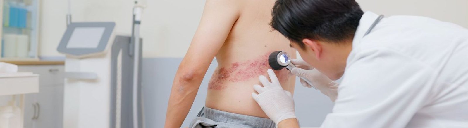 Herpes zóster (culebrilla): síntomas, tratamiento y vacuna en Chile