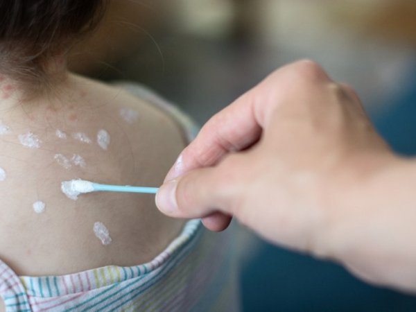 Peste cristal en niños: ¿cómo identificarla y qué cuidados son necesarios?