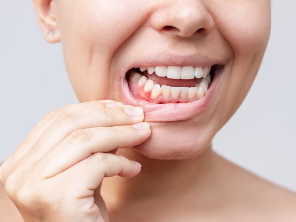 Enfermedad periodontal: más que encías sangrantes