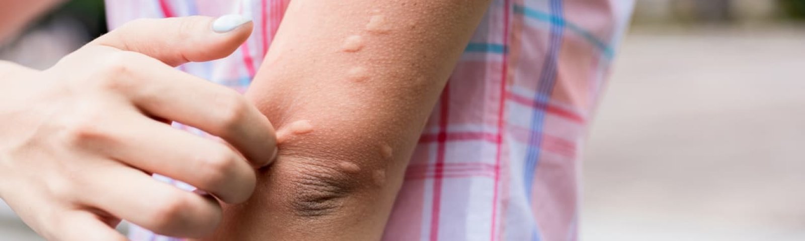 Alergia por estrés: síntomas y tratamientos