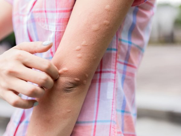 Alergia por estrés: síntomas y tratamientos