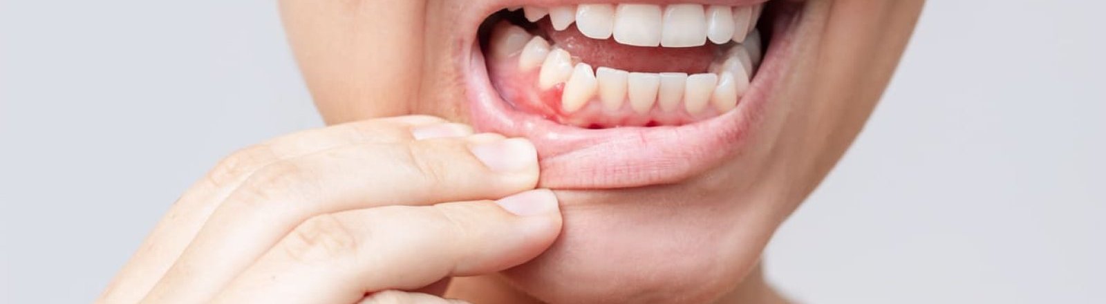 Enfermedad periodontal: más que encías sangrantes