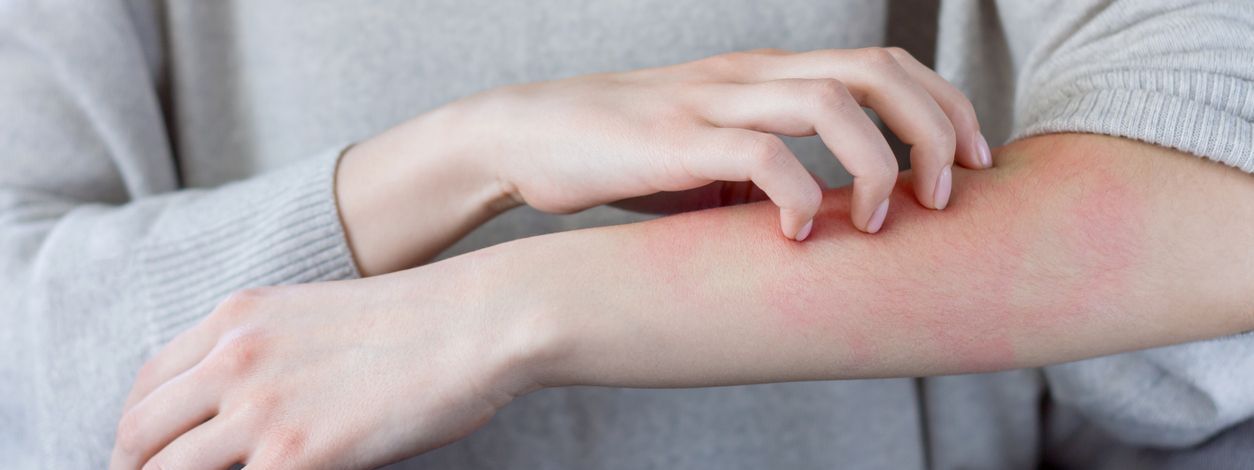 Reacciones en la piel: ¿Cómo identificar y tratar la alergia por estrés?