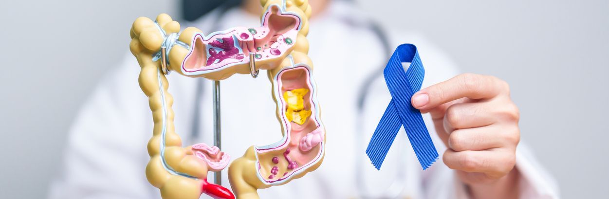 Cáncer de colon: síntomas de alerta y cuándo podría ser necesario realizar una colonoscopia