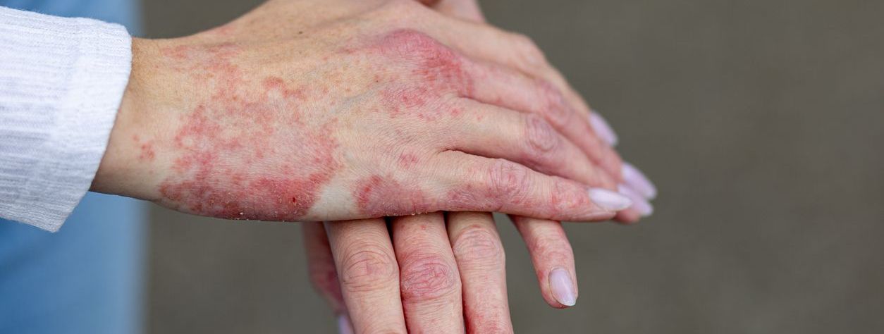 Psoriasis: qué es, por qué aparece y cómo se trata