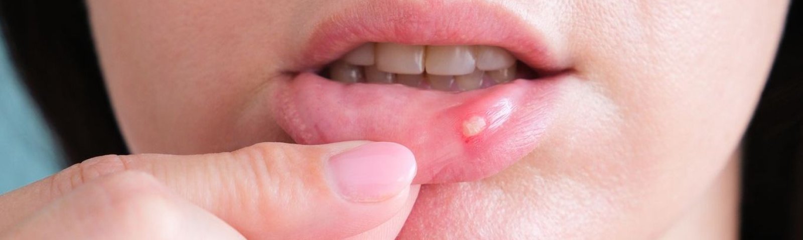 Candidiasis vaginal u oral: Cómo reconocerla y cuándo consultar al médico