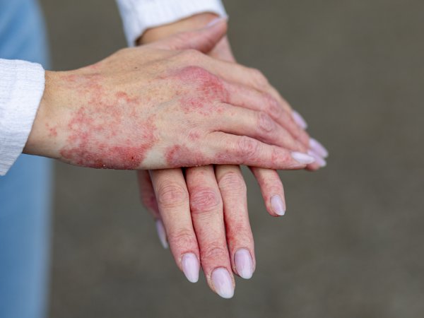 Psoriasis: qué es, por qué aparece y cómo se trata