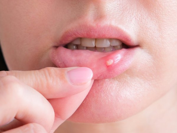 Candidiasis vaginal u oral: Cómo reconocerla y cuándo consultar al médico