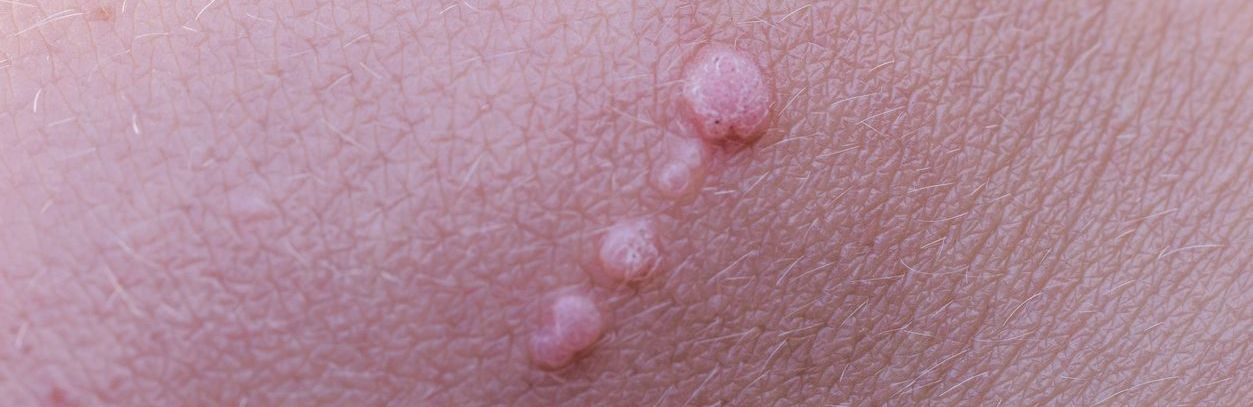 Virus del Papiloma Humano (VPH): qué es, cómo se detecta y cómo prevenirlo