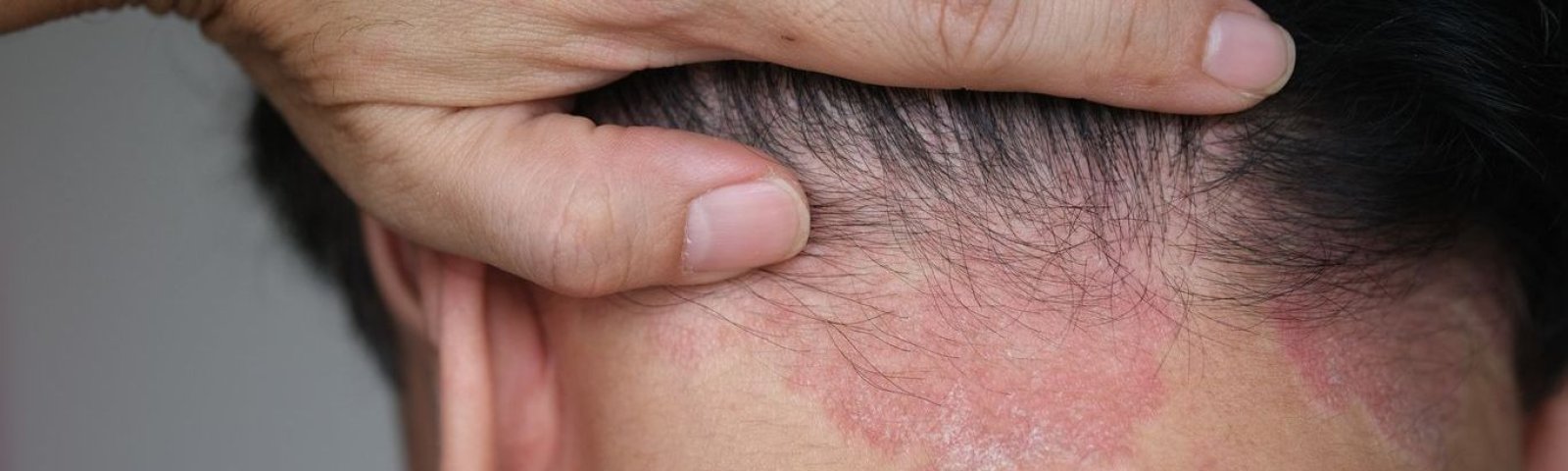 Dermatitis seborréica: causas, síntomas y tratamiento