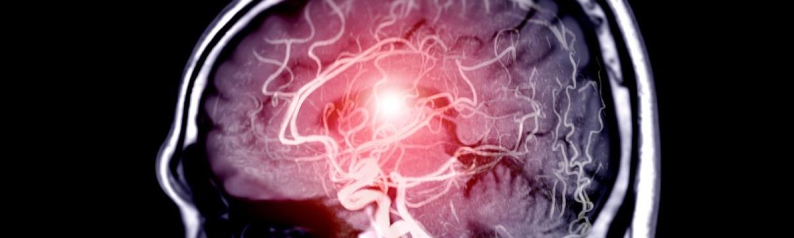 Aneurisma cerebral: qué es, síntomas y cómo detectarlo a tiempo